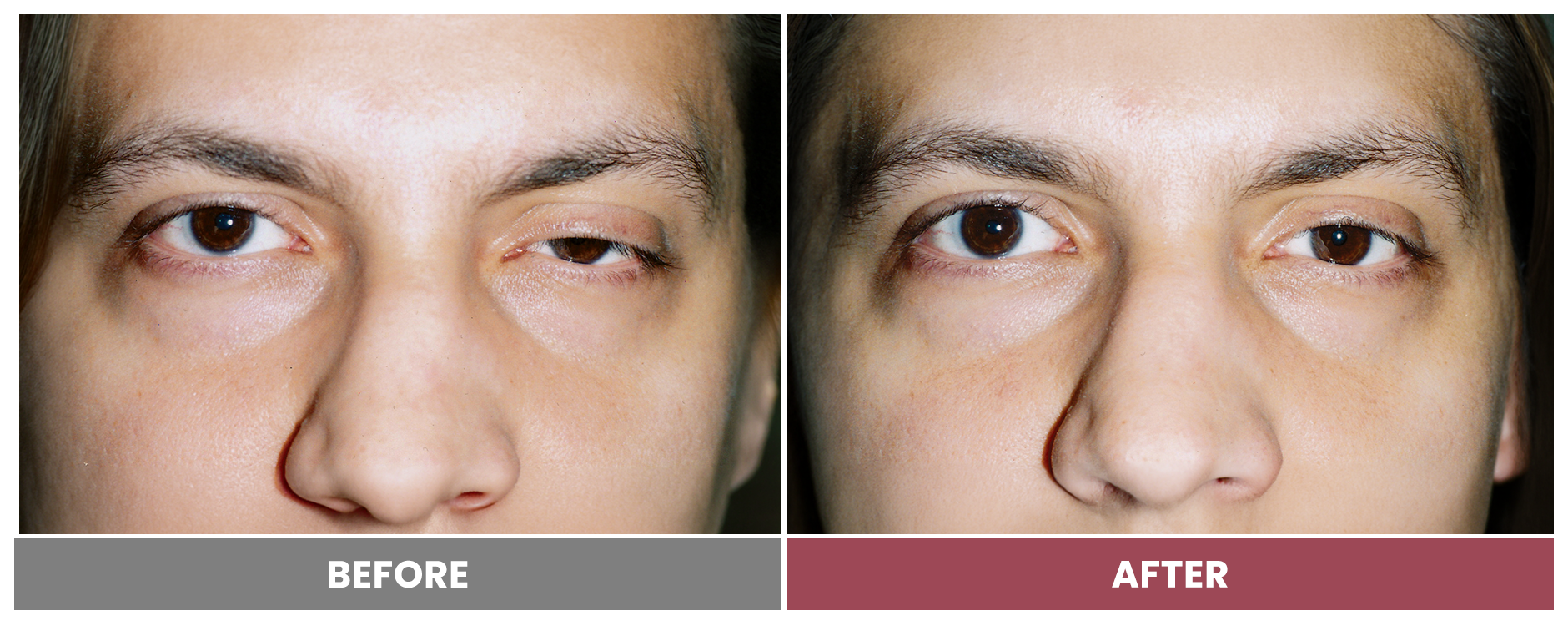 PTOSIS REPAIR - Case 56